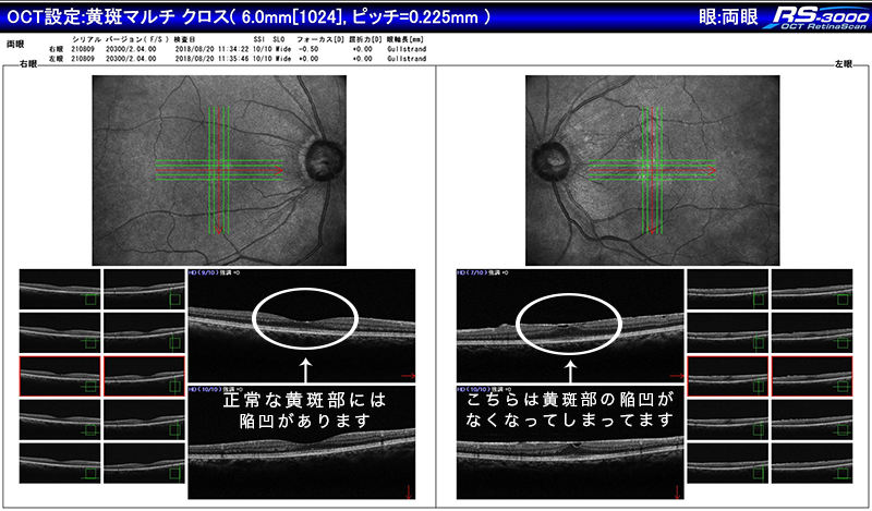 黄斑上膜（網膜上膜）の眼底検査、眼底カメラ
